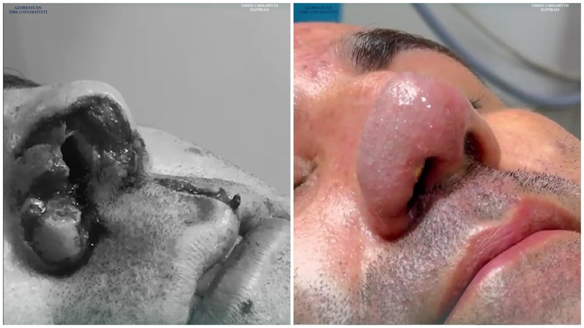 Tədris Cərrahiyyə Klinikasında it dişləməsi nəticəsində zədələnmiş burun uğurla bərpa olundu
